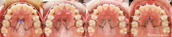 Chỉnh nha-Khí cụ tháo lắp