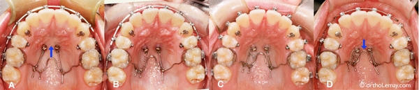 Chỉnh nha-Khí cụ tháo lắp 