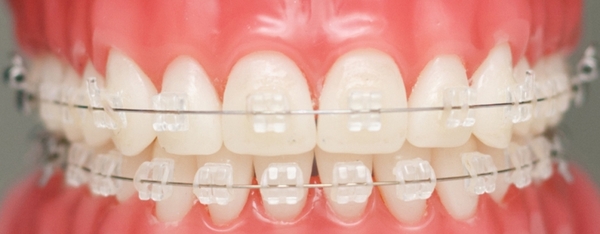 Điều trị chỉnh nha ở trẻ đang phát triển