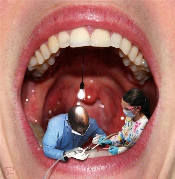 Đeo hàm giữ khoảng ở trẻ em mất răng sữa sớm