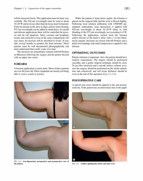 Body Contouring and Liposuction: Expert Consult - Online and Print: Rubin,  J. Peter, Jewell, Mark L., Richter, Dirk, Uebel M.D. Ph.D, Carlos Oscar:  9781455705443: Plastic & Cosmetic:  Canada