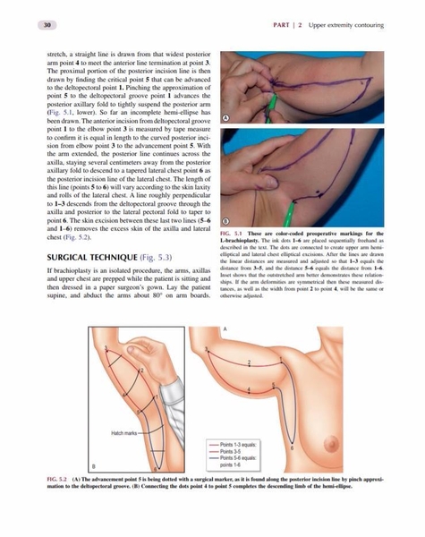 Body Contouring and Liposuction: Expert Consult - Online and Print: Rubin,  J. Peter, Jewell, Mark L., Richter, Dirk, Uebel M.D. Ph.D, Carlos Oscar:  9781455705443: Plastic & Cosmetic:  Canada