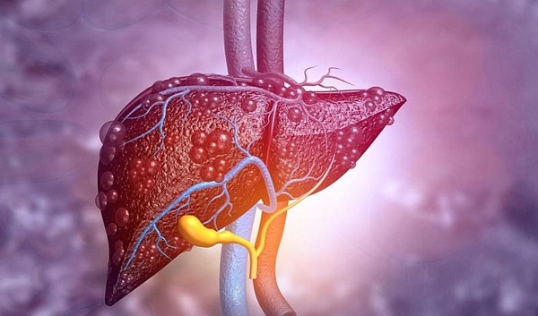 Dấu hiệu của bệnh gan liên quan đến uống rượu