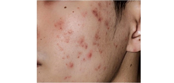 Giấm tre - giải pháp mới chống mụn tự nhiên