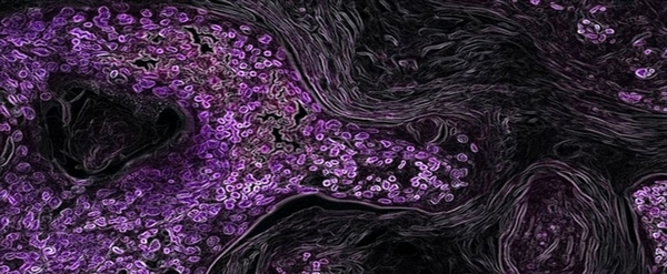 Xác định con đường mới khiến ung thư phát triển mất kiểm soát