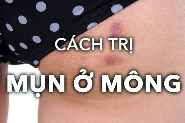 Cách trị mụn ở mông đơn giản và hiệu quả