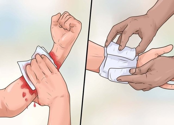 Hướng dẫn sơ cứu vết thương chảy máu Garo vết thương ở tay hoặc chân