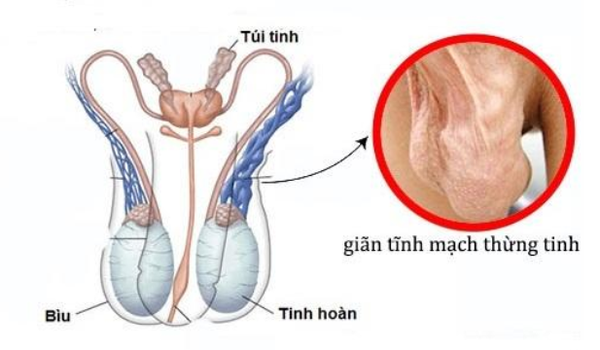 gian-tinh-mach-thung-tinh