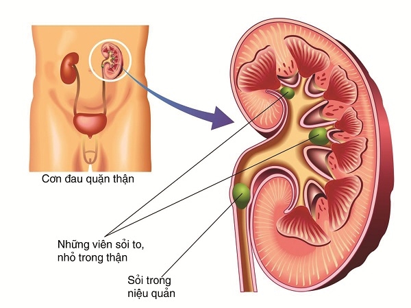 benh-soi-than-la-gi-trieu-chung-cua-benh-soi-than-nhu-the-nao