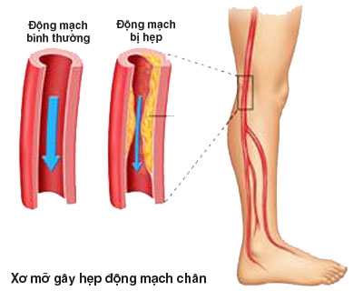 dong-mach-viem-tac