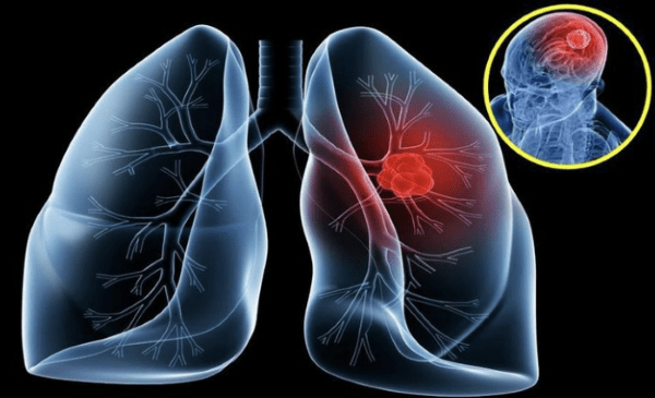 Ung thư phổi bắt nguồn từ đâu?