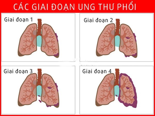 Giai Đoạn của Bệnh: