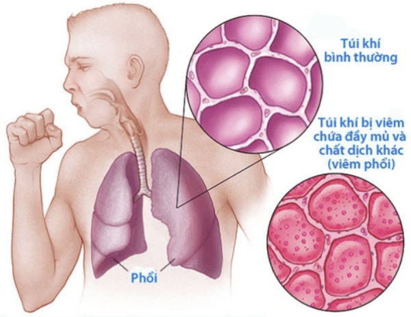 Viêm phổi là gì?