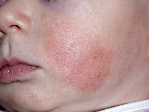 VIÊM DA CƠ ĐỊA Ở TRẺ, NGUYÊN NHÂN VÀ CÁCH NHẬN BIẾT