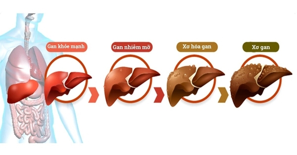 Người bị gan nhiễm mỡ không ăn 5 nhóm thực phẩm này để giảm gánh nặng cho gan!