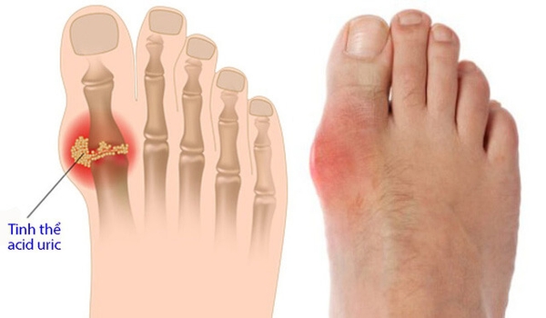 Không ăn hải sản, không uống bia vẫn mắc bệnh gút vì thứ đồ uống nhiều người vẫn dùng hàng ngày