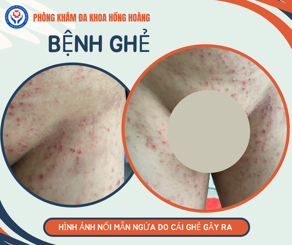 Bệnh ghẻ Phòng Khám Đa Khoa Hồng Hoàng Image hình ảnh hình ảnh hình ảnh hình ảnh hình ảnh hình ảnh hình ảnh hình ảnh hình ảnh Hoàng Ngọc Phách - Bệnh ghẻ Phòng Khám Đa Khoa Hồng Hoàng