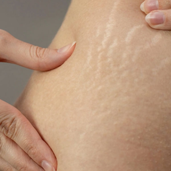 Điều trị rạn