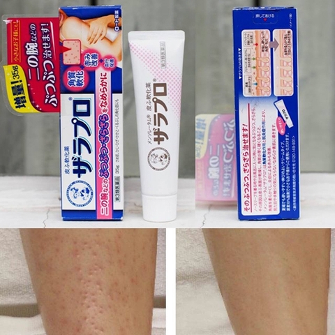 Kem trị viêm nang lông Rohto Zaraporo 35g