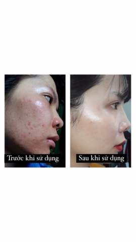 Serum trị mụn - LP-II ANCE-COLLAGE SERUM 5IN1