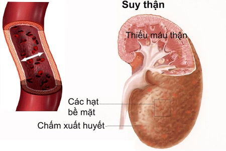 Dinh dưỡng trong bệnh đái tháo đường - suy thận