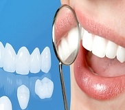 Các loại phục hình răng giả cố định