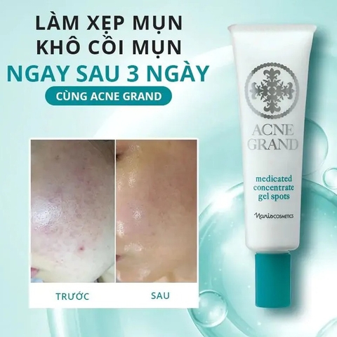 Gel Ngừa Mụn Naris Acne Grand Medicated Concentrate Gel Spots 20g