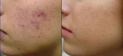 Tẩy sẹo bằng rau má - Mẹo hay cho phái đẹp