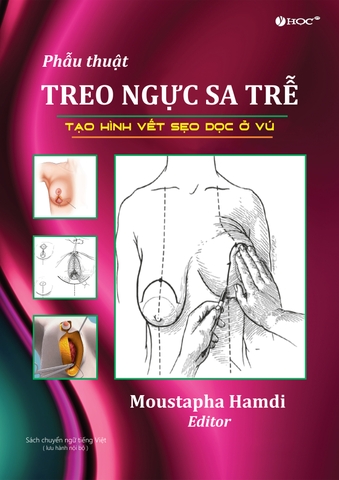 PHẪU THUẬT TREO NGỰC SA TRỄ – TẠO HÌNH VẾT SẸO DỌC Ở VÚ