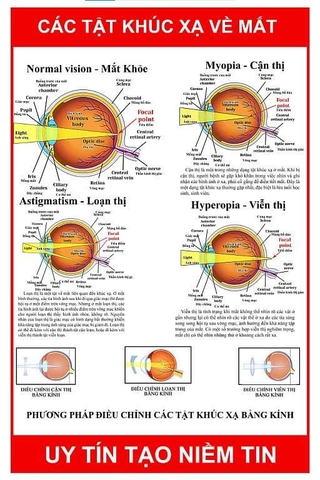 Tranh treo các tật khúc xạ về mắt ( Kích thước ngang 50 cm. Cao 75 cm)
