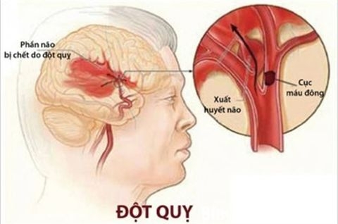 Homocysteine phát hiện, đánh giá bệnh tim mạch, đột quỵ