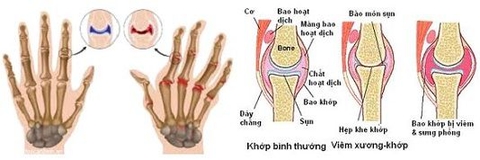 Viêm khớp và các xét nghiệm chẩn đoán