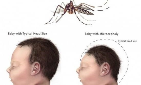 Virus Zika gây dị tật bẩm sinh