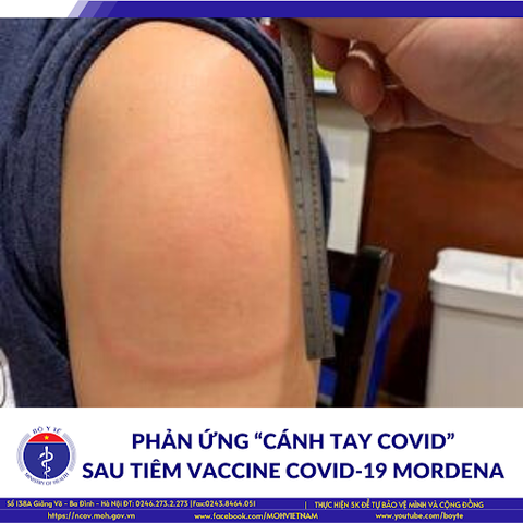 Cánh tay COVID sau tiêm vacxin công nghệ mRNA