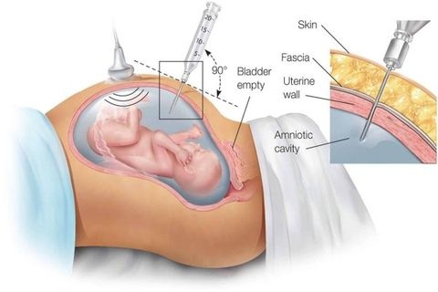 Xét nghiệm DNA huyết thống trước sinh xâm lấn