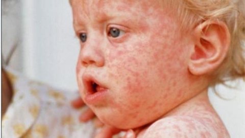 Bệnh Rubella có nguy hiểm không?