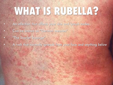 Hiểu biết cơ bản bệnh Rubella