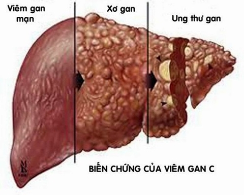 Các biến chứng nguy hiểm của virus viêm gan C