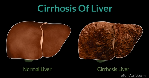 Bệnh xơ gan (cirrhosis) - phần 1