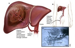 Các khối u gan
