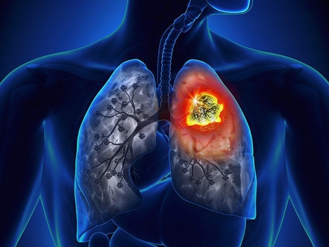 ProGRP - Dấu ấn ung thư phổi tế bào nhỏ