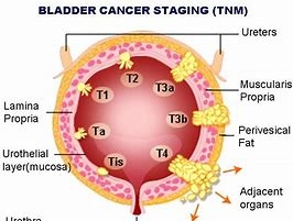 TPA - Dấu ấn ung thư bàng quang