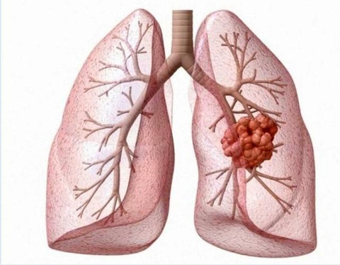 Xét nghiệm máu phát hiện sớm ung thư phổi