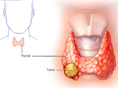 Thyroglobulin (TG) - Dấu ấn ung thư tuyến giáp