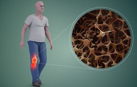Thuốc bimagrumab có thể chống lại mất cơ và loãng xương sau khi giảm cân nhanh