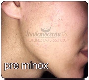 Thuốc mọc râu Minoxidil 5% combo 2 lọ tặng Bơm zin