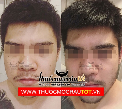 Thuốc mọc râu Minoxidil 5% dạng lỏng combo Beard Oil 20ml