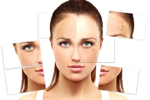 Cách Trị nám tàn nhang hiệu quả nhất với những thứ đơn giản