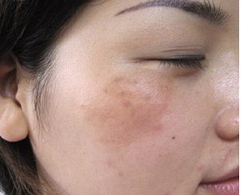 15 PHÚT XÓA NÁM DA BẰNG NHA ĐAM SAO KHÔNG THỬ
