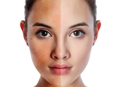 Mổ xẻ nguyên nhân hàng đầu gây ra nám